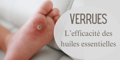 Verrues: l'efficacité des huiles essentielles